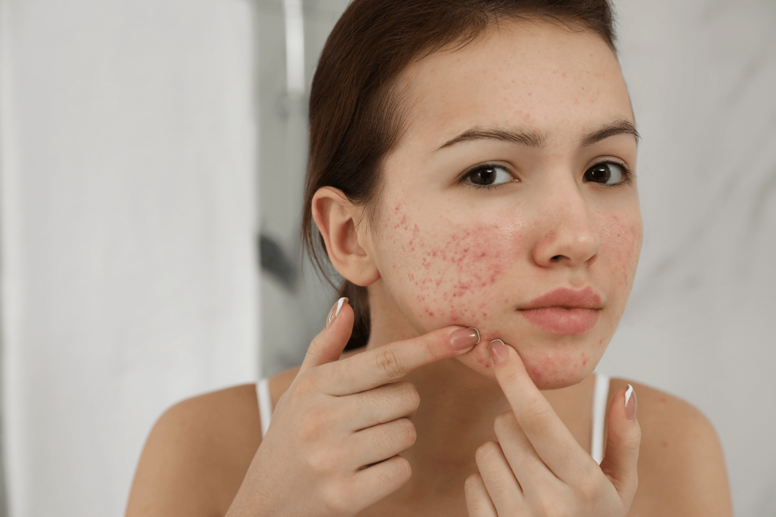 Does Dandruff Cause Acne – Dandruff’s Influence on Acne