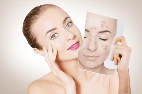 How to get acne free glowing skin naturally, acne free skin