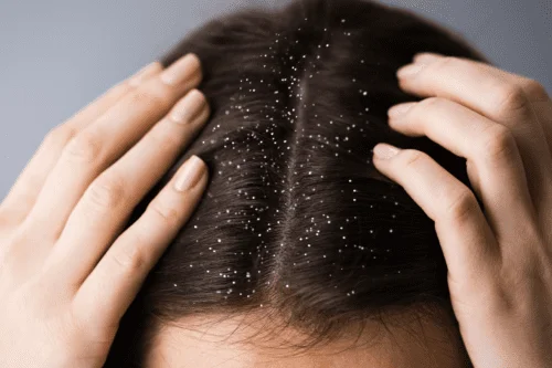 Does Dandruff cause Acne, dandruff