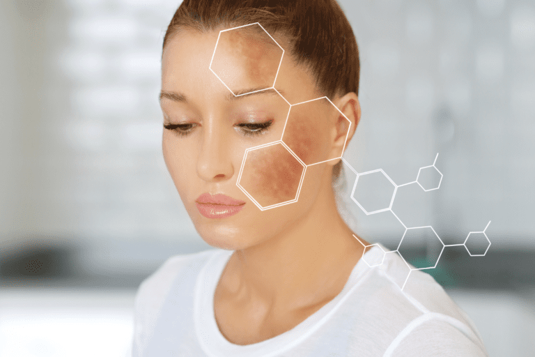 How to decrease melanin in skin