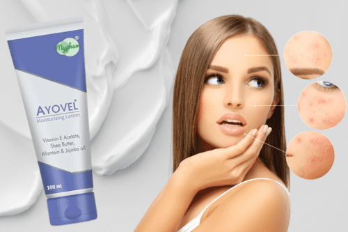 Which Moisturizer is Best for Acne Prone Skin