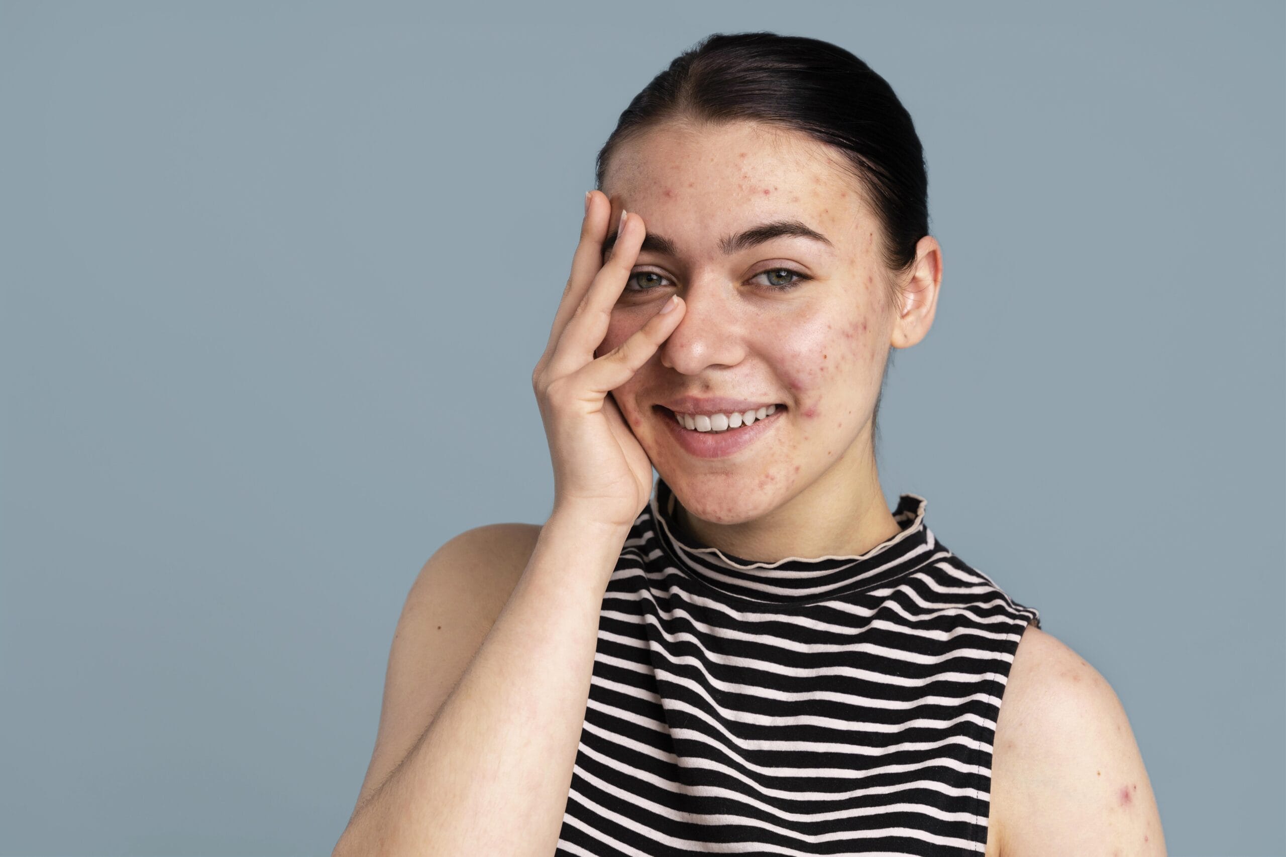 Moisturizer for Acne-Prone Skin